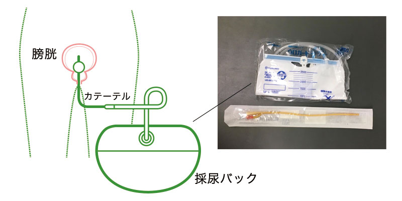 バルーン カテーテル 看護