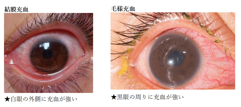 結膜充血と結毛充血