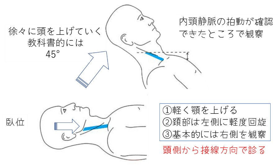 頸静脈の診察　診察の実際