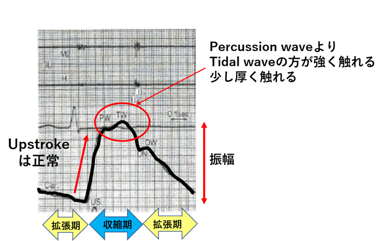 図2 正常の頸動脈波形(高齢)　