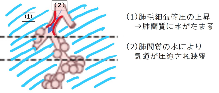 イメージ：心不全・肺水腫