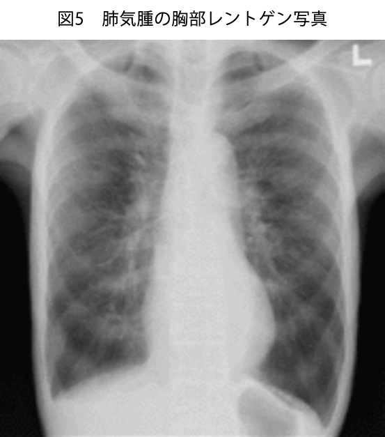 図5 肺気腫の胸部レントゲン写真